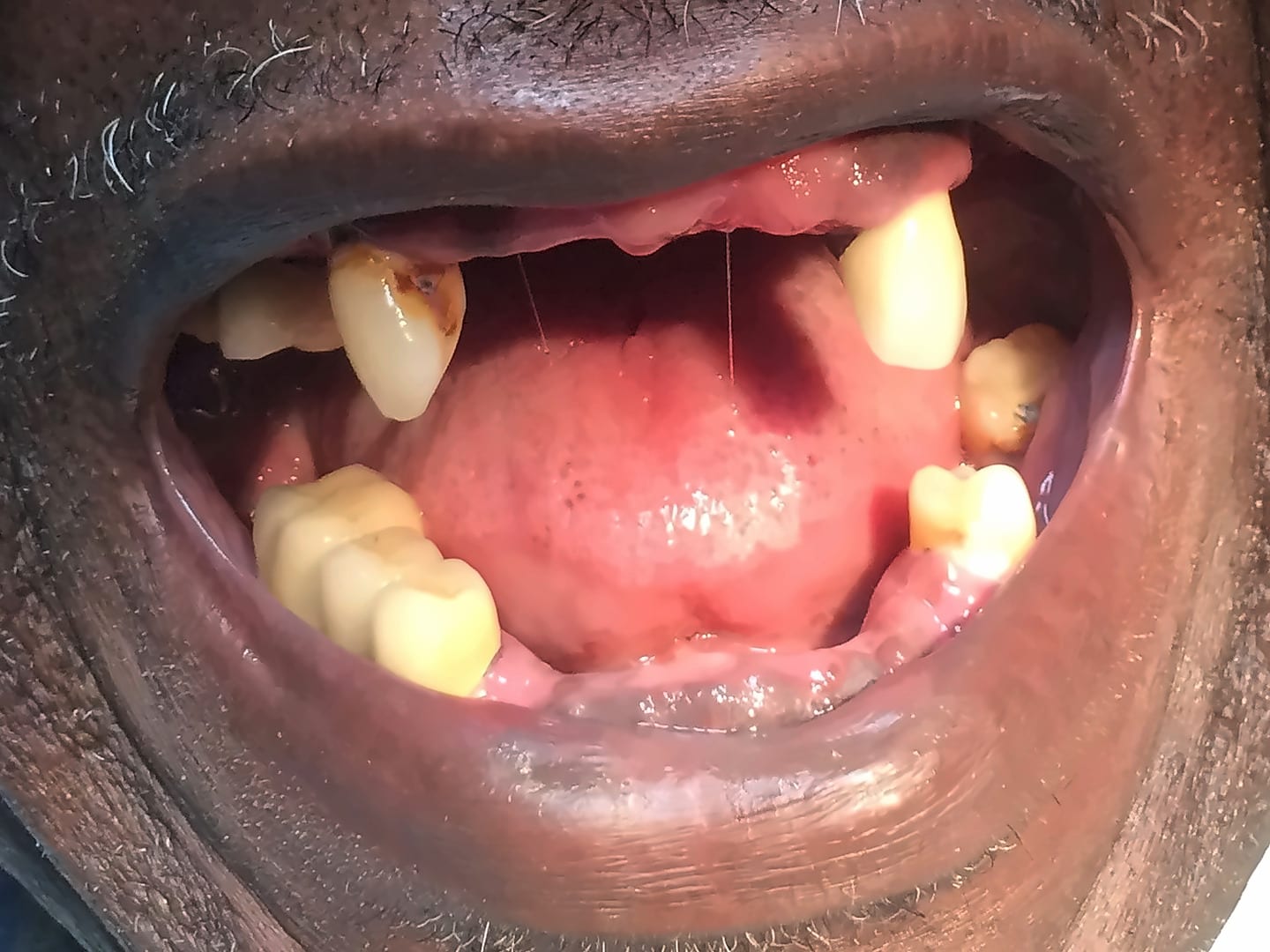 Before: several missing and worn teeth